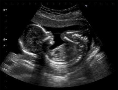 Utah House committee approves ultrasound abortion bill
